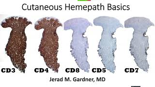 Cutaneous Hemepath 101 Skin Lymphoma Leukemia amp Histiocytic Infiltrate Basics Hematopathology [upl. by Meirrak]