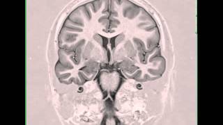 Mesial Temporal Sclerosis Right [upl. by Oniliuqnart]