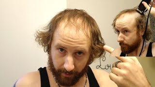 BALDING MAN Shaves Head Bald TOTALLY TRANSFORMING His Look [upl. by Aldwin438]