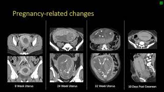 Gynecologic Radiology Anatomy [upl. by Adnaval]