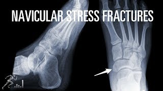 How can you quickly recover from a navicular stress fracture [upl. by Tsai713]