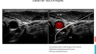 Stellate Ganglion Block [upl. by Rodolfo]