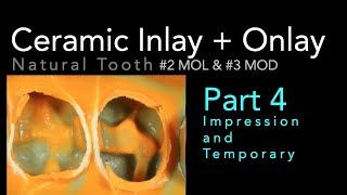 Lithium Disilicate Ceramics Part 4 Impression and Temporary [upl. by Lianna839]