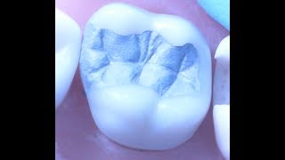 Class II Amalgam Restoration 1  Operative Dentistry [upl. by Lorine]