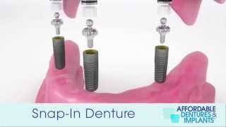 Demo How Do SnapIn Dentures With Implants Work [upl. by Bronwen]