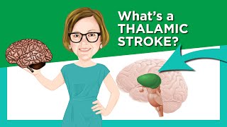 Thalamic Stroke [upl. by Humo]