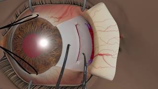 Strabismus surgery Recession [upl. by Nalim869]