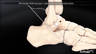 Instabilité de la cheville  ligamentoplastie sous arthroscopie [upl. by Nayb]