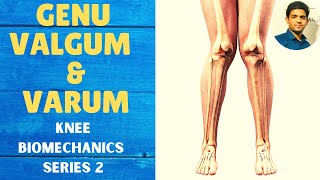 GENU VALGUM amp GENU VARUM  Knee Complex Biomechanics [upl. by Ynot]