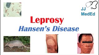 Leprosy Hansens disease  Who is at risk Signs and Symptoms Diagnosis and Treatment [upl. by Abroms]