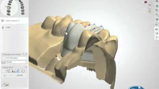 Intro to Dental CADCAM  Plan [upl. by Tutankhamen]