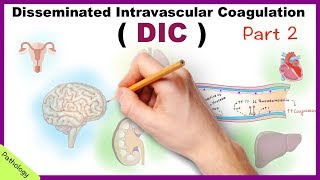 DIC Disseminated Intravascular Coagulation  Part 2 [upl. by Ruhtracam887]