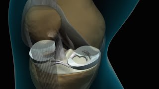 Torn Knee Meniscus Repair [upl. by Sension]