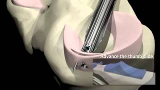 Arthroscopic Meniscus Repair [upl. by Annaul]