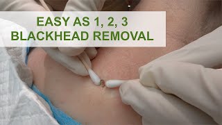 Easy as 1 2 3 Blackhead Removal  Dr Derm [upl. by Snodgrass917]