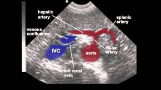 Abdominal Aortic Aneurysm AAA Ultrasound [upl. by Cochran214]